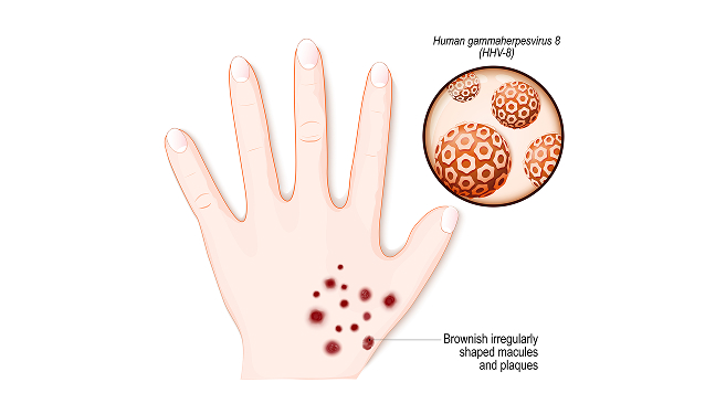 Karposi's sarcoma