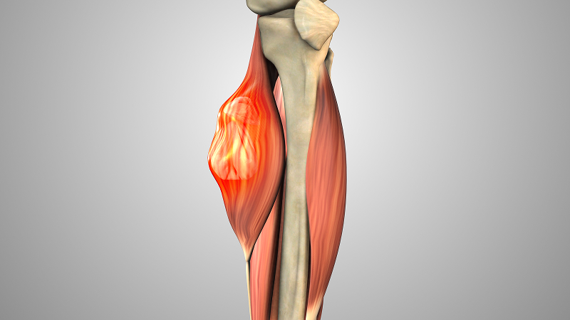 Soft tissue sarcoma